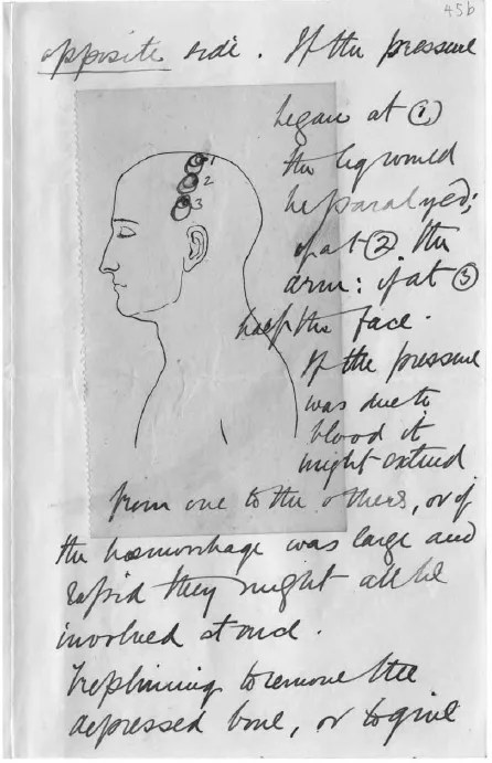 Bram’s working notes: sketch of a depressed skull fracture (Renfield)
